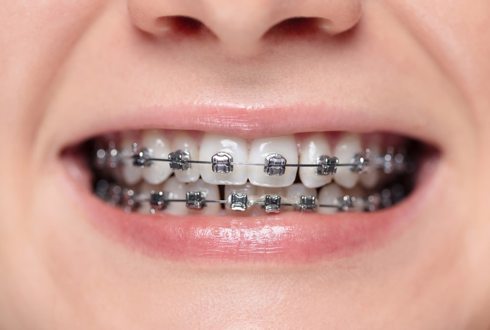 Braces South Jordan